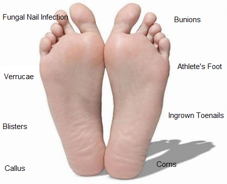 Common Foot Problems | Newcastle Sports Injury Clinic